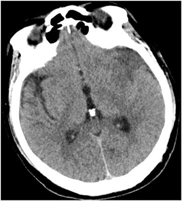 Successful Intravenous Thrombolysis in Ischemic Stroke Caused by Tuberculous Meningitis: A Case Report
